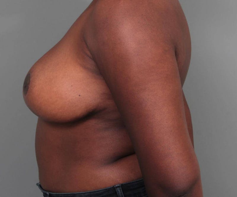 Breast Reduction Before & After Gallery - Patient 309027 - Image 6 - Scott Chapin, MD