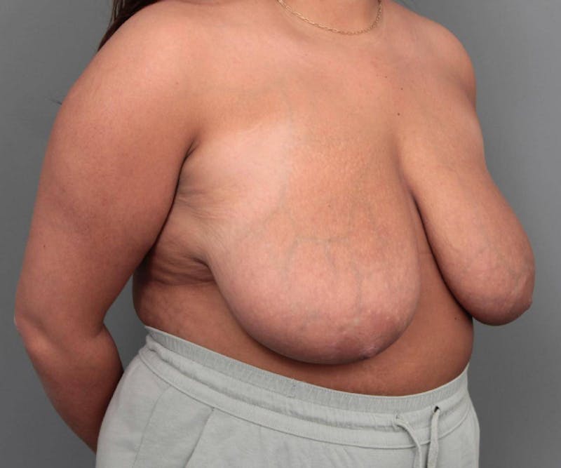 Breast Reduction Before & After Gallery - Patient 247650 - Image 3 - Scott Chapin, MD