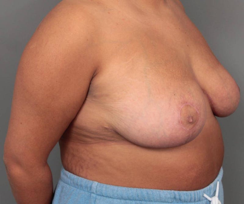 Breast Reduction Before & After Gallery - Patient 247650 - Image 4 - Scott Chapin, MD