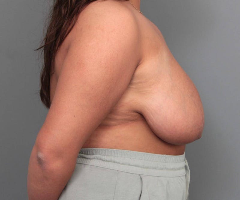Breast Reduction Before & After Gallery - Patient 247650 - Image 5 - Scott Chapin, MD