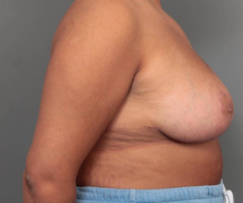 Breast Reduction Before & After Gallery - Patient 247650 - Image 6 - Scott Chapin, MD