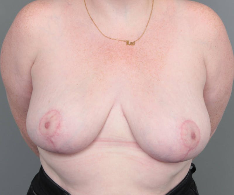 Breast Reduction Before & After Gallery - Patient 405956 - Image 2 - Scott Chapin, MD