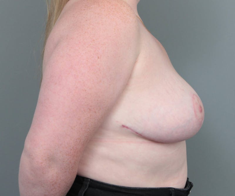 Breast Reduction Before & After Gallery - Patient 405956 - Image 6 - Scott Chapin, MD