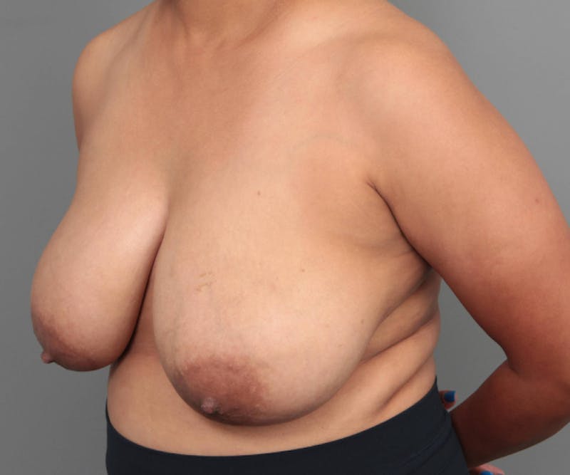 Breast Reduction Before & After Gallery - Patient 104174 - Image 3 - Scott Chapin, MD