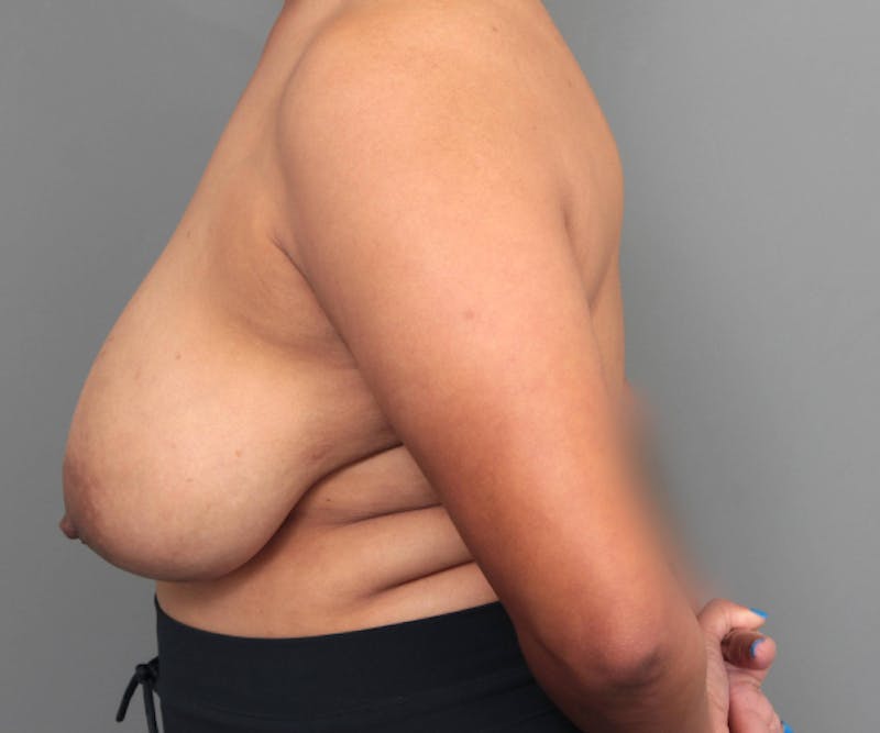 Breast Reduction Before & After Gallery - Patient 104174 - Image 5 - Scott Chapin, MD