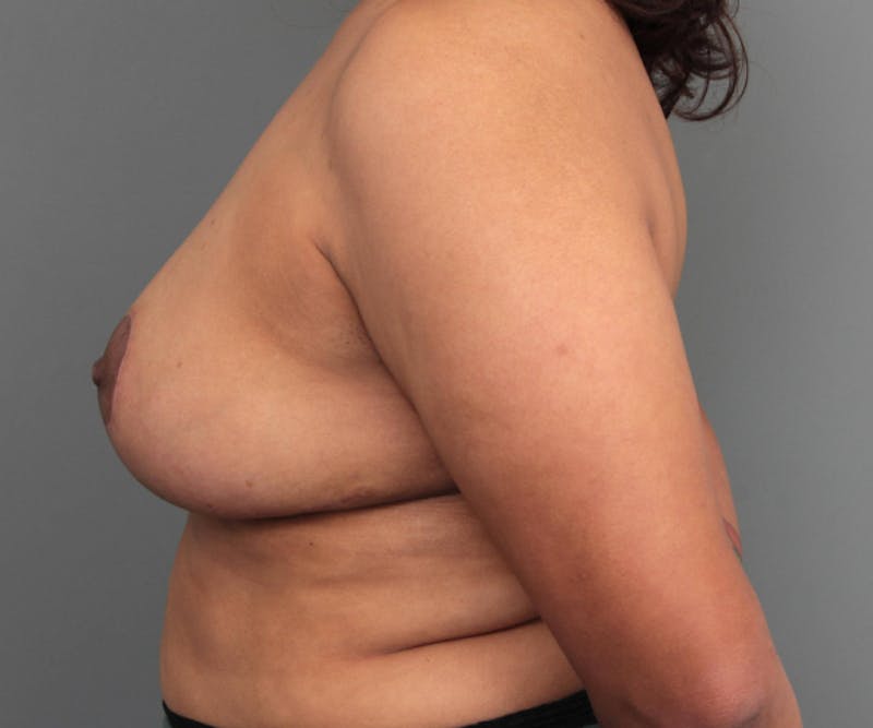 Breast Reduction Before & After Gallery - Patient 104174 - Image 6 - Scott Chapin, MD