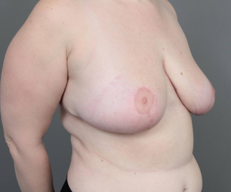 Breast Reduction Before & After Gallery - Patient 302581 - Image 4 - Scott Chapin, MD