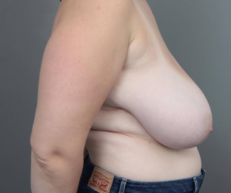 Breast Reduction Before & After Gallery - Patient 302581 - Image 5 - Scott Chapin, MD