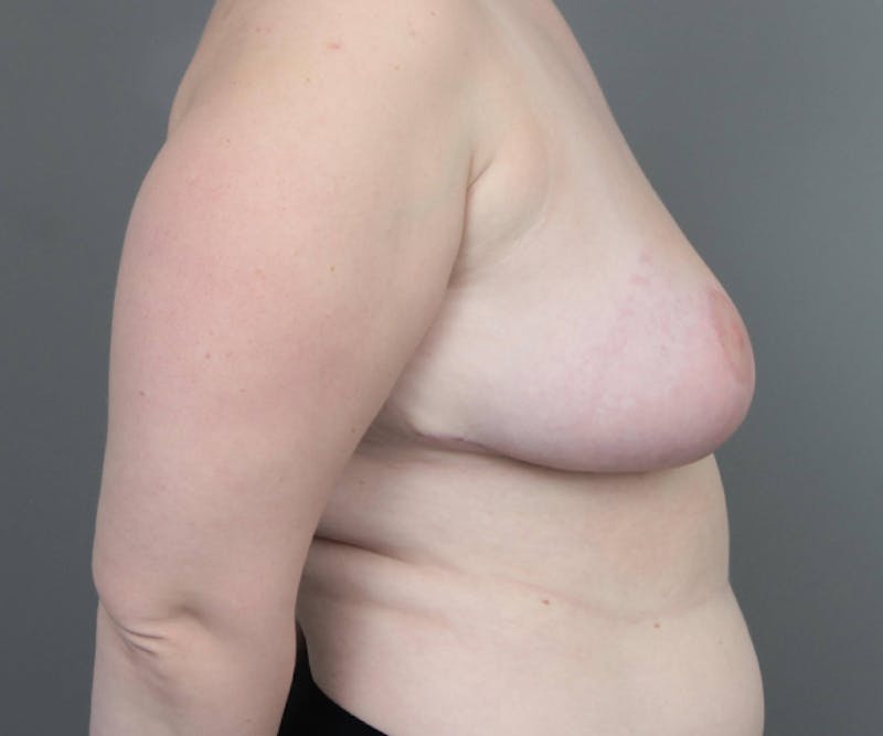 Breast Reduction Before & After Gallery - Patient 302581 - Image 6 - Scott Chapin, MD