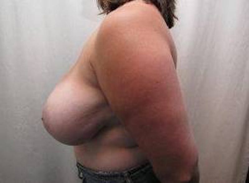 Breast Reduction Before & After Gallery - Patient 255872 - Image 3 - Scott Chapin, MD