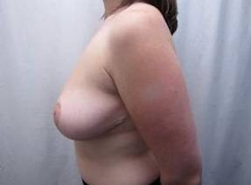 Breast Reduction Before & After Gallery - Patient 255872 - Image 4 - Scott Chapin, MD