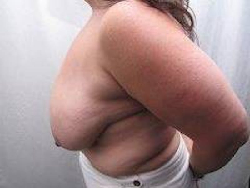Breast Reduction Before & After Gallery - Patient 264188 - Image 1 - Scott Chapin, MD