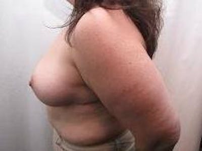 Breast Reduction Before & After Gallery - Patient 264188 - Image 2 - Scott Chapin, MD