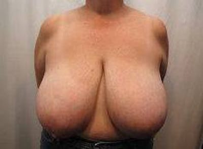 Breast Reduction Before & After Gallery - Patient 219395 - Image 1 - Scott Chapin, MD