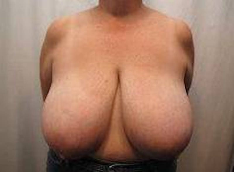 Breast Reduction Before & After Gallery - Patient 219395 - Image 1 - Scott Chapin, MD