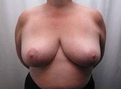Breast Reduction Before & After Gallery - Patient 219395 - Image 2 - Scott Chapin, MD