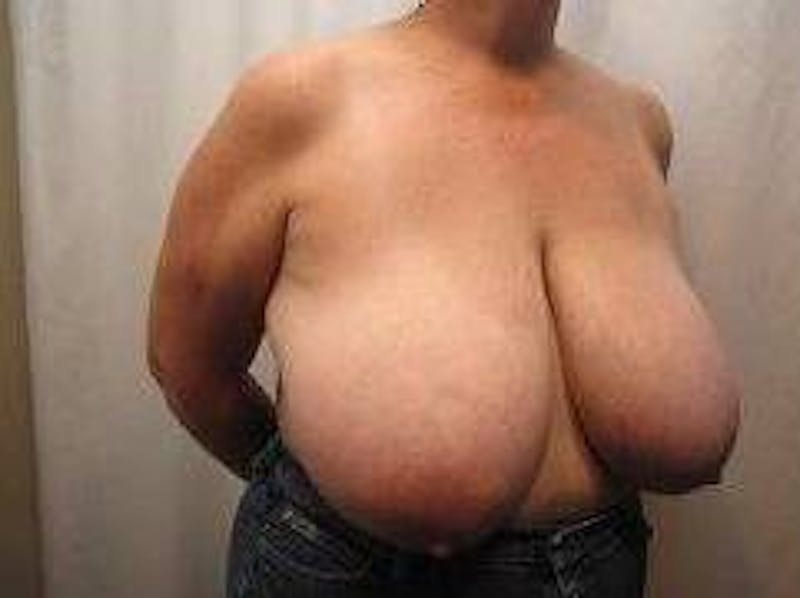 Breast Reduction Before & After Gallery - Patient 219395 - Image 3 - Scott Chapin, MD