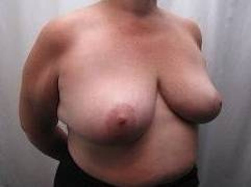 Breast Reduction Before & After Gallery - Patient 219395 - Image 4 - Scott Chapin, MD