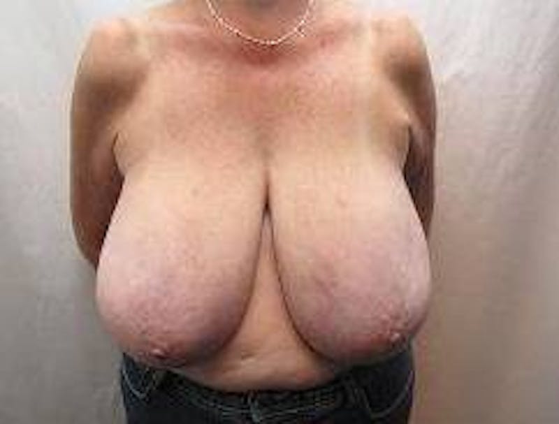 Breast Reduction Before & After Gallery - Patient 232176 - Image 1 - Scott Chapin, MD