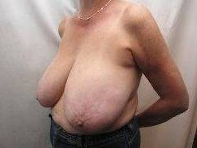 Breast Reduction Before & After Gallery - Patient 232176 - Image 5 - Scott Chapin, MD