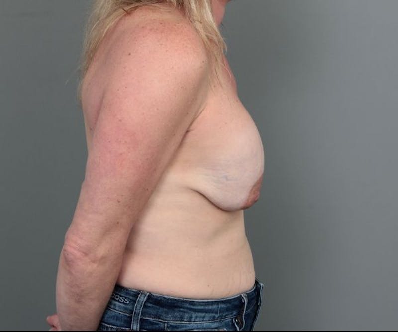 Breast Revision Before & After Gallery - Patient 317687 - Image 5 - Scott Chapin, MD