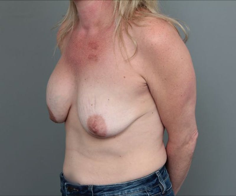 Breast Revision Before & After Gallery - Patient 317687 - Image 7 - Scott Chapin, MD