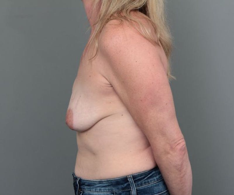 Breast Revision Before & After Gallery - Patient 317687 - Image 9 - Scott Chapin, MD