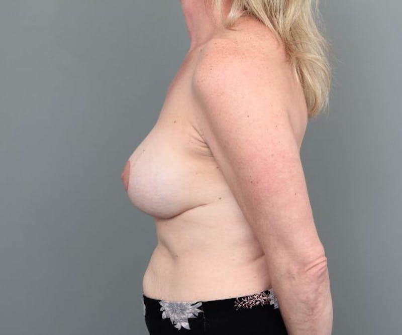 Breast Revision Before & After Gallery - Patient 317687 - Image 10 - Scott Chapin, MD