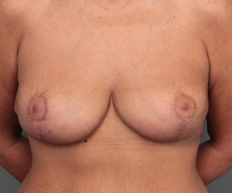 Breast Revision Before & After Gallery - Patient 330306 - Image 2 - Scott Chapin, MD
