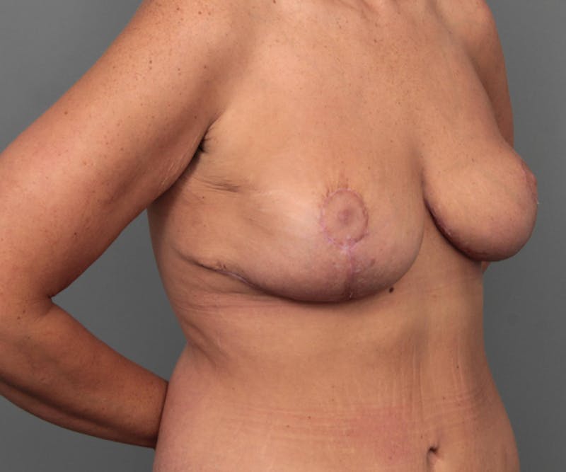 Breast Revision Before & After Gallery - Patient 330306 - Image 4 - Scott Chapin, MD