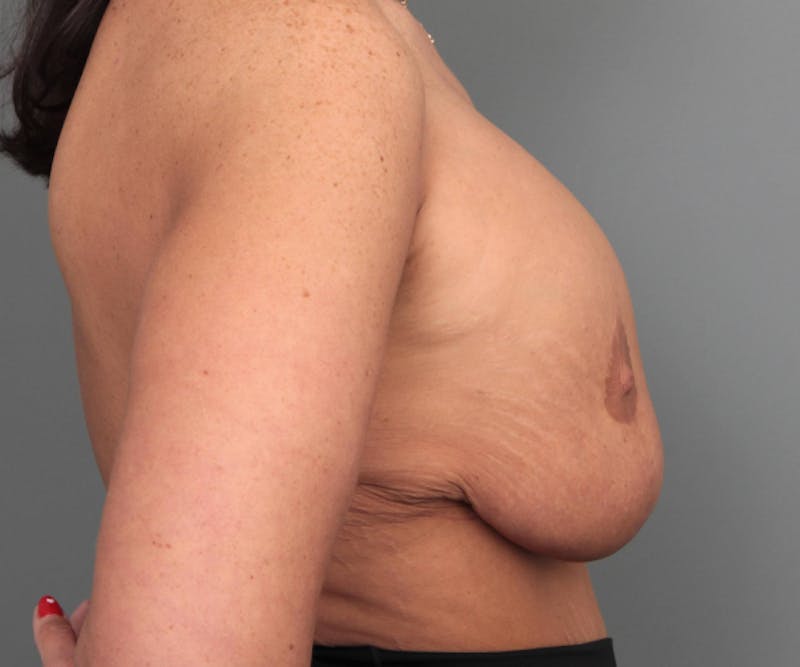 Breast Revision Before & After Gallery - Patient 330306 - Image 5 - Scott Chapin, MD