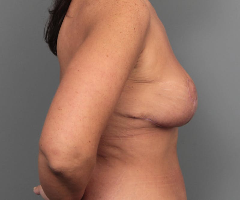 Breast Revision Before & After Gallery - Patient 330306 - Image 6 - Scott Chapin, MD