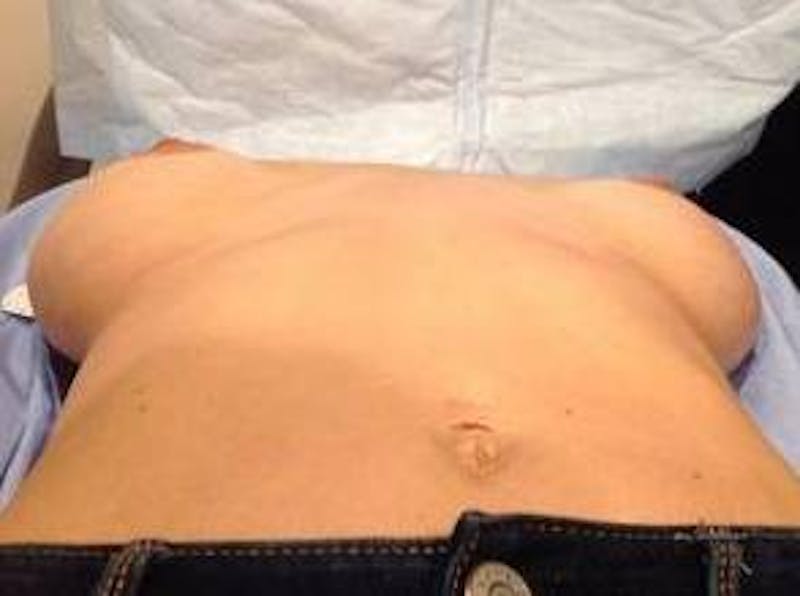 Breast Revision Before & After Gallery - Patient 301567 - Image 5 - Scott Chapin, MD