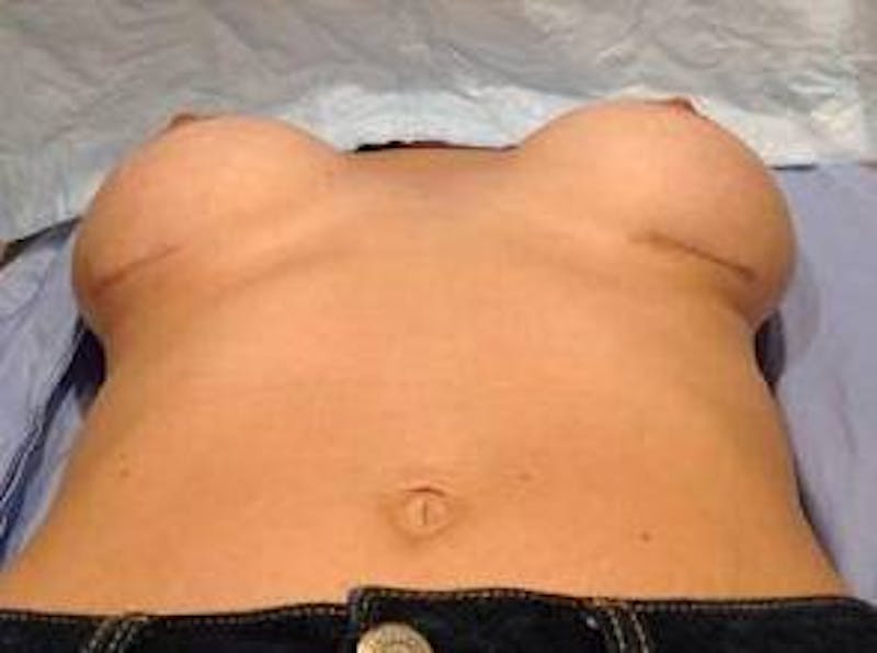 Breast Revision Before & After Gallery - Patient 301567 - Image 6 - Scott Chapin, MD
