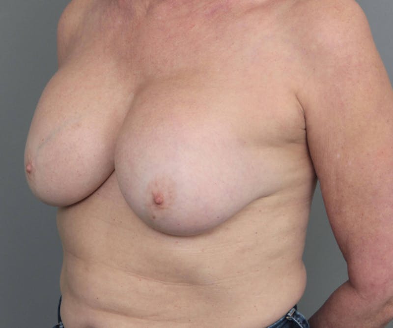 Breast Revision Before & After Gallery - Patient 389587 - Image 3 - Scott Chapin, MD