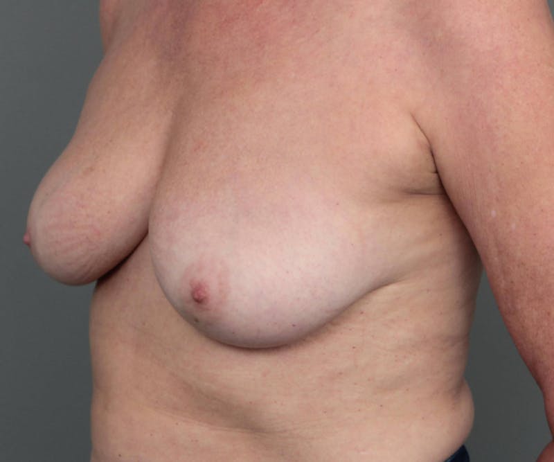 Breast Revision Before & After Gallery - Patient 389587 - Image 4 - Scott Chapin, MD