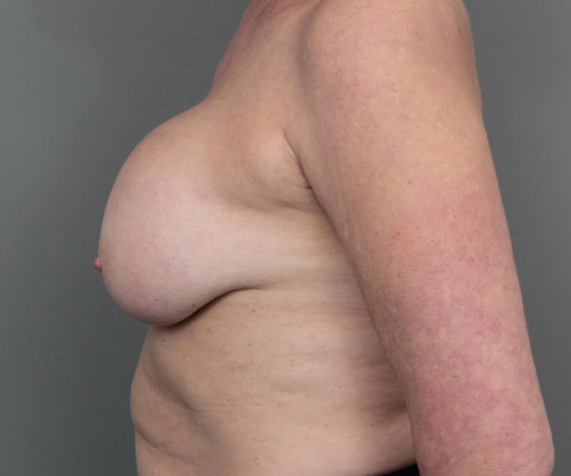 Breast Revision Before & After Gallery - Patient 389587 - Image 5 - Scott Chapin, MD