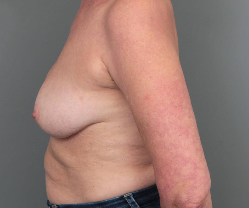 Breast Revision Before & After Gallery - Patient 389587 - Image 6 - Scott Chapin, MD