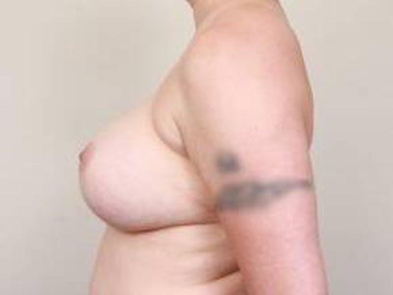 Breast Revision Before & After Gallery - Patient 809428 - Image 3 - Scott Chapin, MD