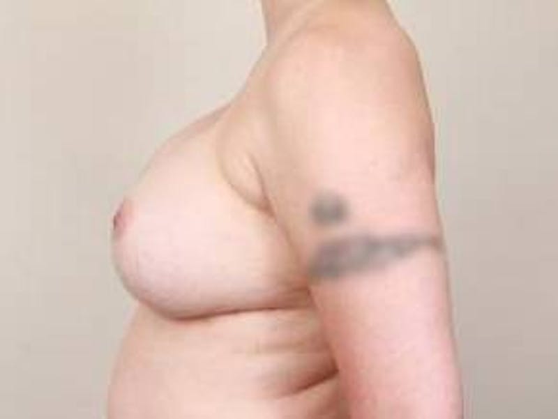 Breast Revision Before & After Gallery - Patient 809428 - Image 4 - Scott Chapin, MD