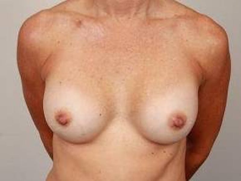 Breast Revision Before & After Gallery - Patient 368728 - Image 2 - Scott Chapin, MD