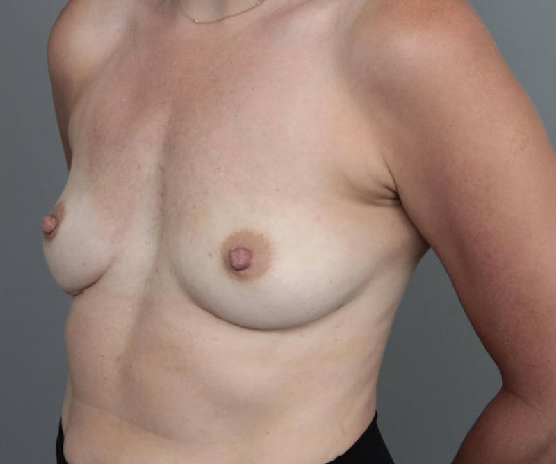 Breast Revision Before & After Gallery - Patient 178431 - Image 4 - Scott Chapin, MD
