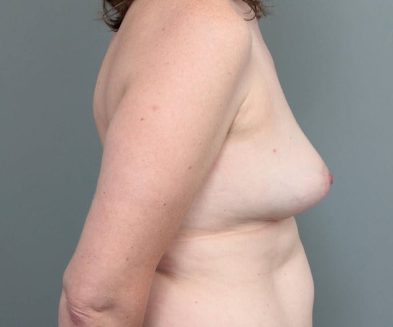 Breast Revision Before & After Gallery - Patient 161443 - Image 10 - Scott Chapin, MD