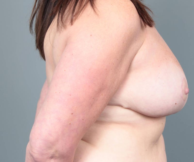 Breast Implant Removal Before & After Gallery - Patient 886475 - Image 8 - Scott Chapin, MD