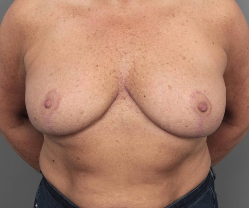 Breast Implant Removal Before & After Gallery - Patient 580814 - Image 2 - Scott Chapin, MD