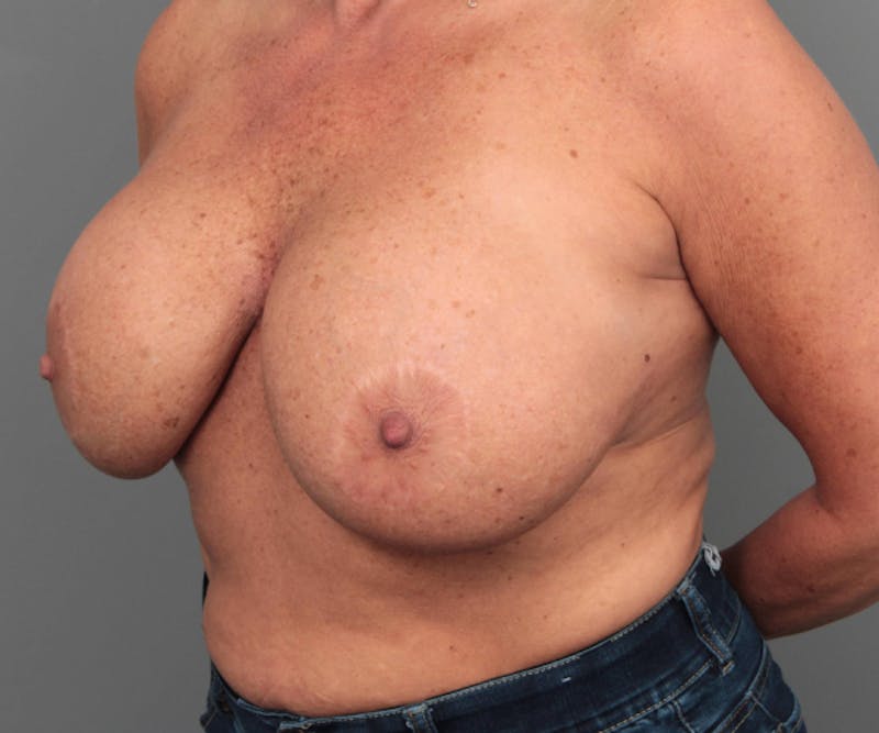 Breast Implant Removal Before & After Gallery - Patient 580814 - Image 3 - Scott Chapin, MD
