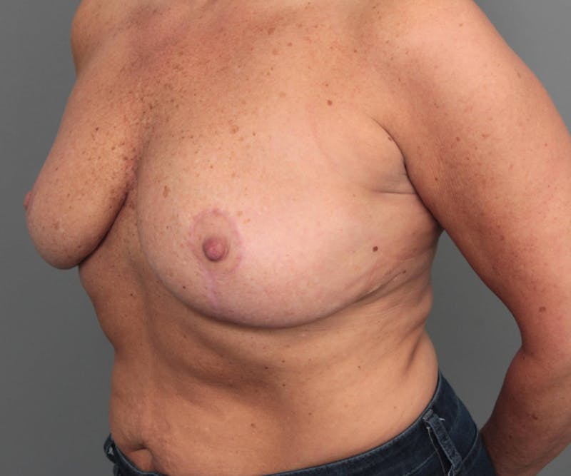 Breast Implant Removal Before & After Gallery - Patient 580814 - Image 4 - Scott Chapin, MD
