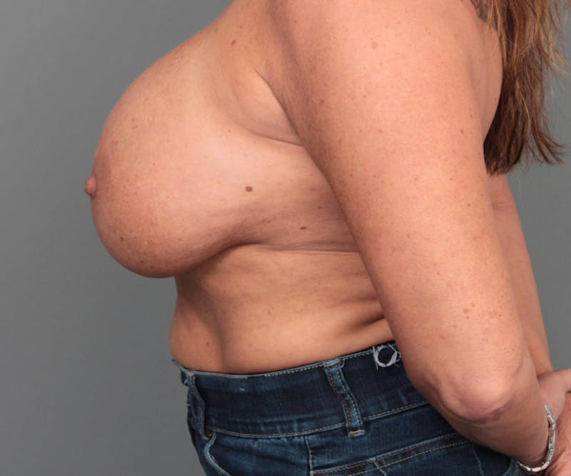 Breast Implant Removal Before & After Gallery - Patient 580814 - Image 5 - Scott Chapin, MD