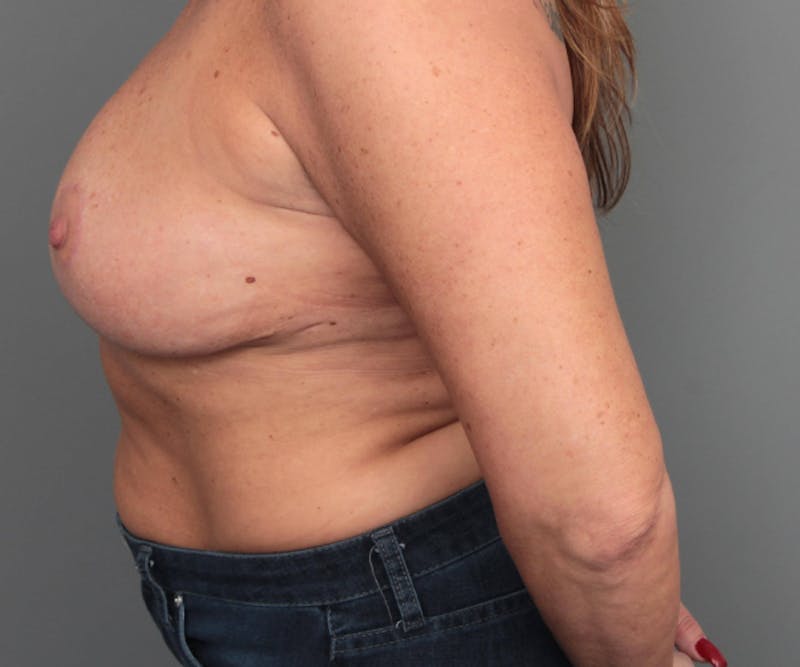 Breast Implant Removal Before & After Gallery - Patient 580814 - Image 6 - Scott Chapin, MD