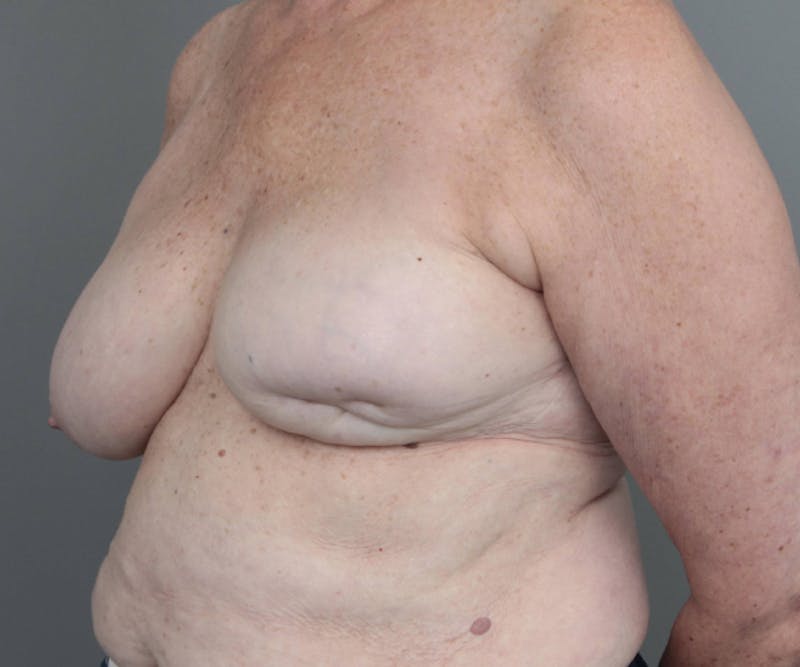 Breast Reconstruction Before & After Gallery - Patient 171934 - Image 3 - Scott Chapin, MD